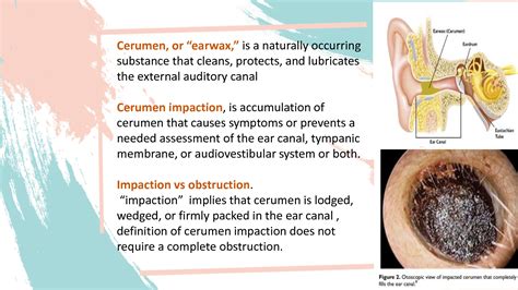 10 Ways To Identify Ear Wax Impaction Icd 10