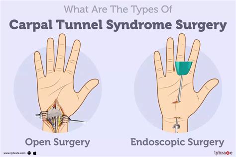 5 Codes For Carpal Tunnel Surgery Explained