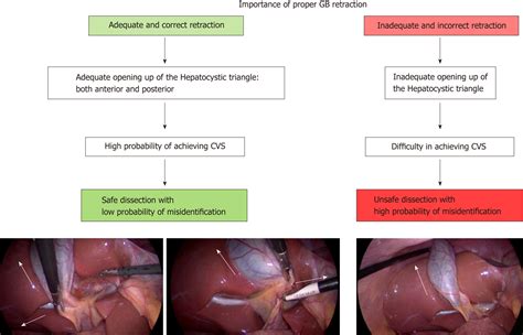 5 Essential Cpt Codes For Lap Cholecystectomy Procedures