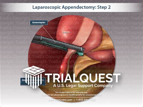 5 Essential Cpt Codes For Laparoscopic Appendectomy