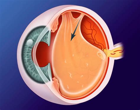 5 Essential Facts About Posterior Vitreous Detachment Icd 10