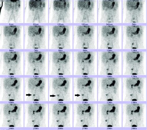 5 Icd 10 Codes For Rectal Bleeding Explained