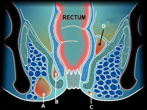 5 Key Facts About Icd 10 Perirectal Abscess