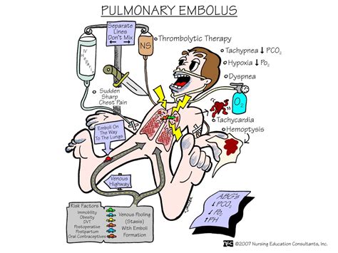 5 Nursing Diagnosis For Pulmonary Embolism