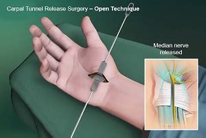 5 Tips For Carpal Tunnel Release Surgery