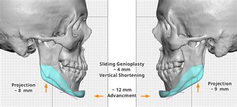 5 Ways A Steep Mandibular Plane Angle Affects Your Bite