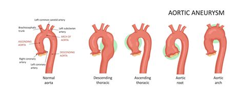 5 Ways Aortic Root Dilation Icd 10 Impacts Diagnosis