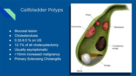 5 Ways To Code Icd 10 Gallbladder Polyp Accurately