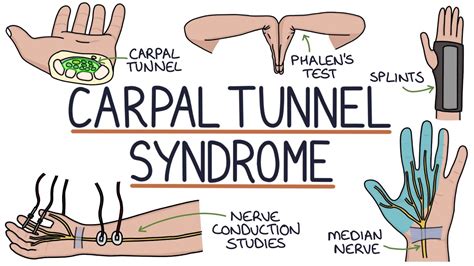 5 Ways To Cope With Bilateral Carpal Tunnel Syndrome