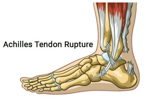 5 Ways To Diagnose Achilles Tendon Rupture Icd 10