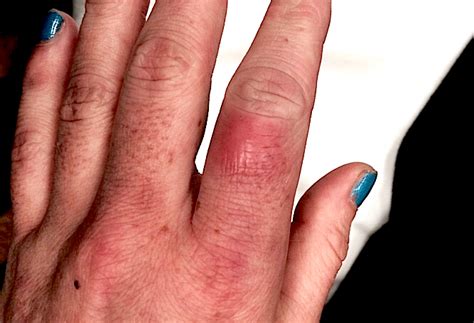 5 Ways To Diagnose Cellulitis Left Hand With Icd 10