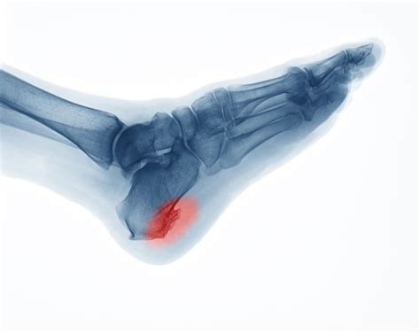 5 Ways To Diagnose Heel Spur With Icd 10