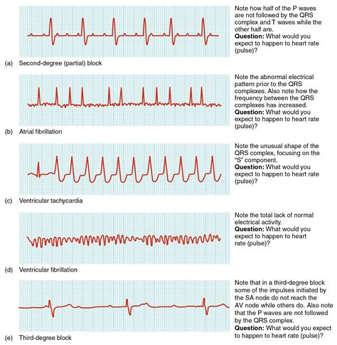 6 Abnormal Ecg Findings In Icd 10