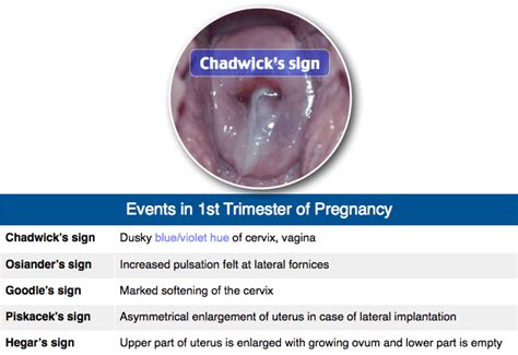 Chadwicks Signs Of Pregnancy: Early Detection Guide