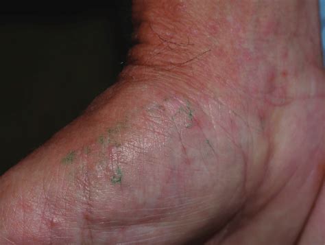 Detecting Scabies: The Burrow Ink Test Explained