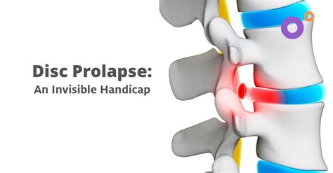 Disc Prolapse Icd 10: A Comprehensive Guide For Diagnosis