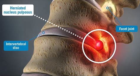 Hernia Nucleus Pulposus: Icd 10 Code And Treatment Guide