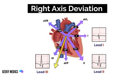 Left Axis Deviation Icd 10 Explained Simply