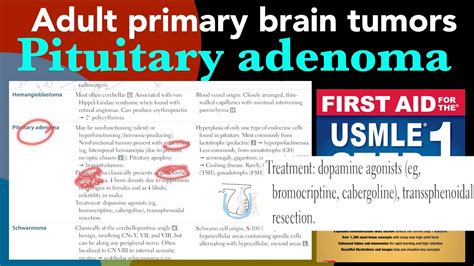 Pituitary Adenoma Usmle Uworld: A Comprehensive Study Guide