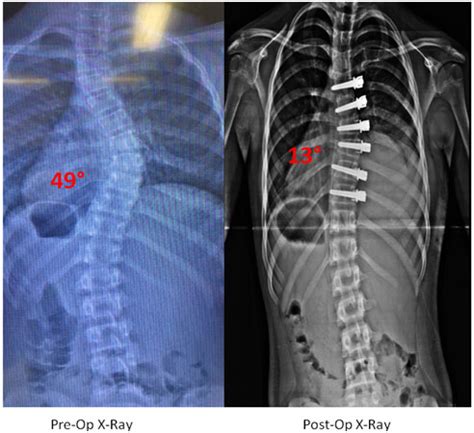 Scoliosis Solutions Mn: Non-Surgical Spinal Correction Experts