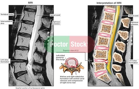 Understanding Bulging Disc: 5 Key Icd-10 Codes